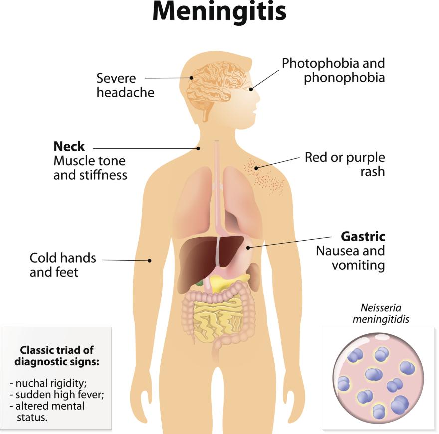 Illustration of meningitis symptoms
